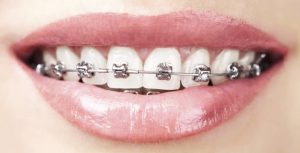 aparate dentare